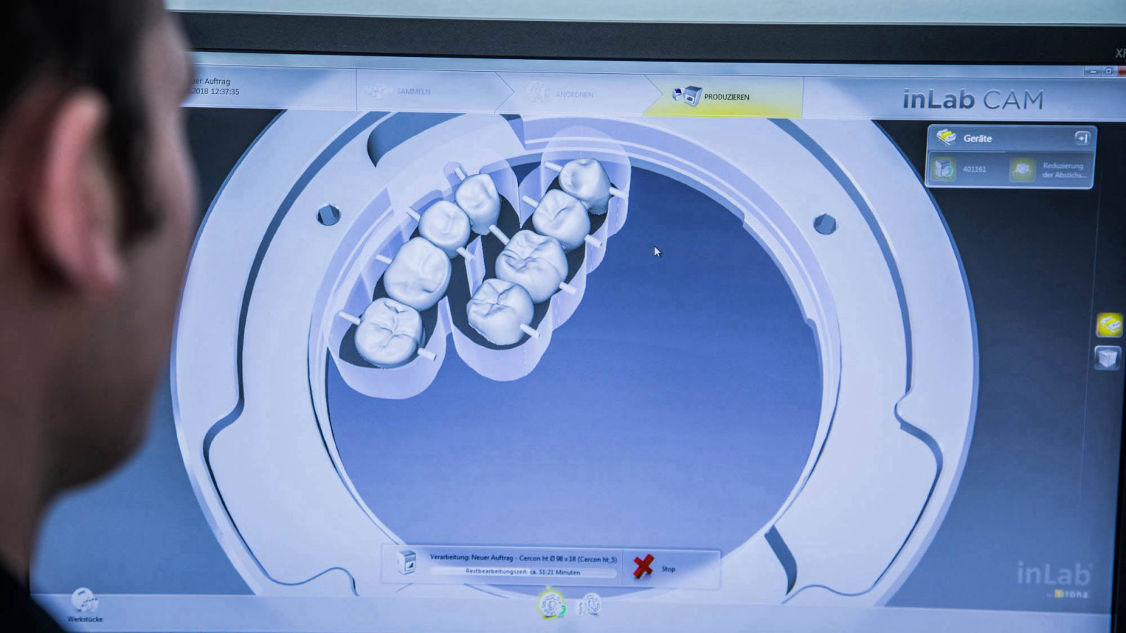 Vollkeramischer Zahnersatz 